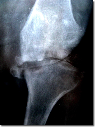 RX d’une arthrose de genou destructrice