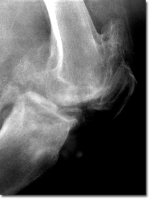 RX d’une arthrose de genou de profil