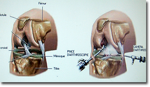 Le lavage articulaire sous arthroscopie -