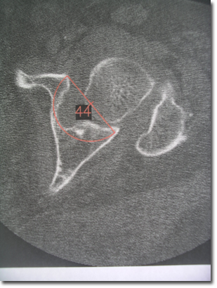 Scanner horizontal d’une arthrose de hanche